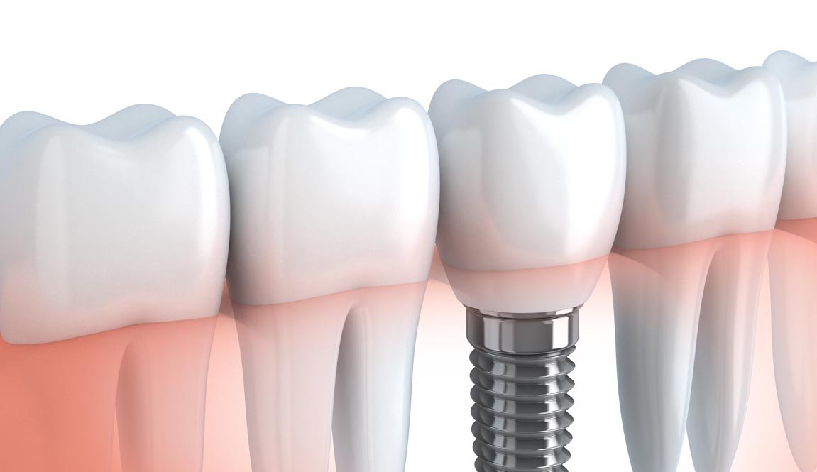 Clínica Dental Dr Salvador Bernabeu implantes