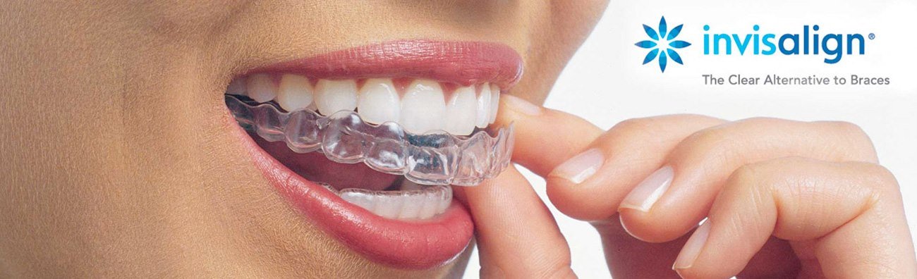 Clínica Dental Dr Salvador Bernabeu Invisalign Alargada