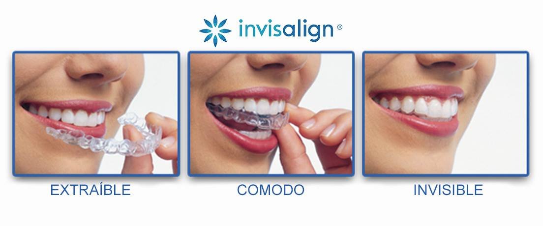 Clínica Dental Dr Salvador Bernabeu Invisaglin